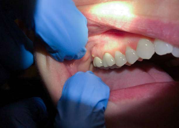 Best Urgent Care for Lost Fillings or Crowns in Derwood, MD